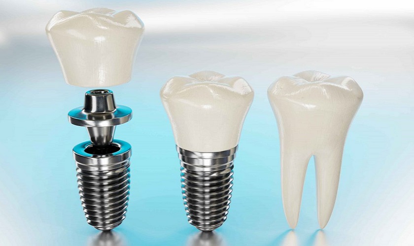 Trồng răng Implant có đắt không và 5 yếu tố quyết định