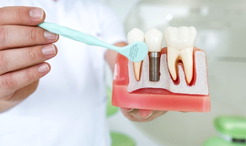 Trồng răng Implant giữ được bao lâu? Có vĩnh viễn không?