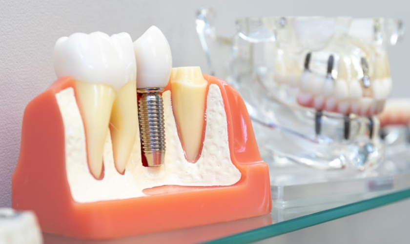 Trồng răng Implant không rạch lợi tại Implant Center