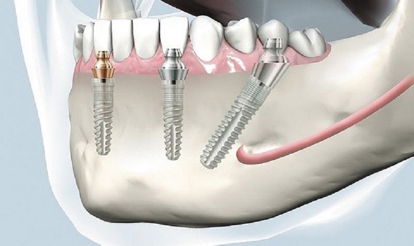 Trồng răng Implant ở người mắc bệnh xương khớp có ảnh hưởng gì không?