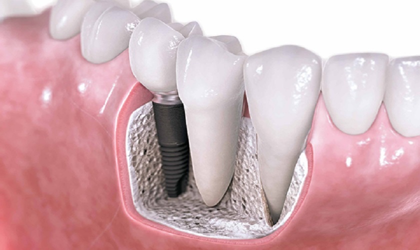 Những điều cần biết khi trồng răng Implant sau xạ trị hóa trị