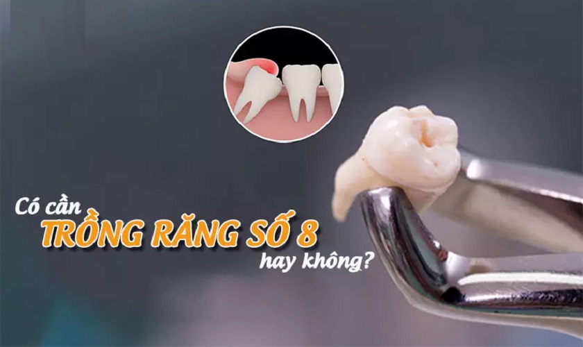 Trồng răng số 8 sau khi nhổ có cần thiết không?