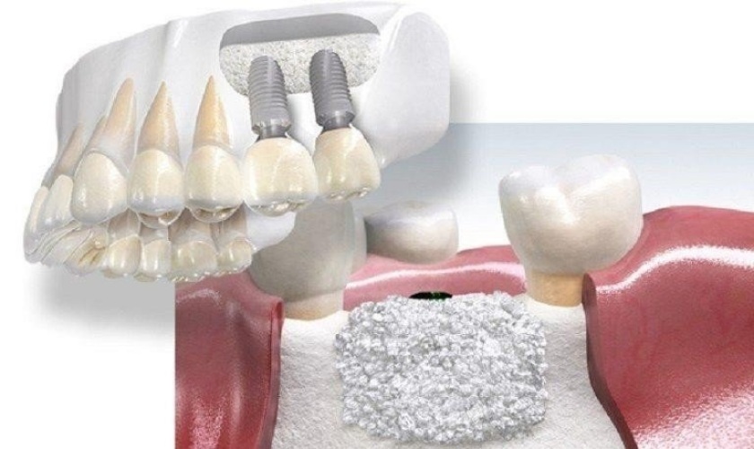 Trường hợp cần nâng xoang trong cấy ghép Implant