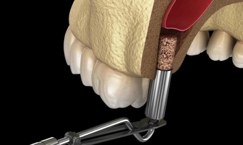Trường hợp cần nâng xoang trong cấy ghép Implant