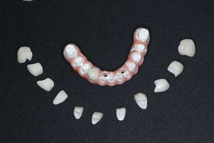 BioHPP - Vật liệu tiên tiến đột phá trong phẫu thuật Implant toàn hàm