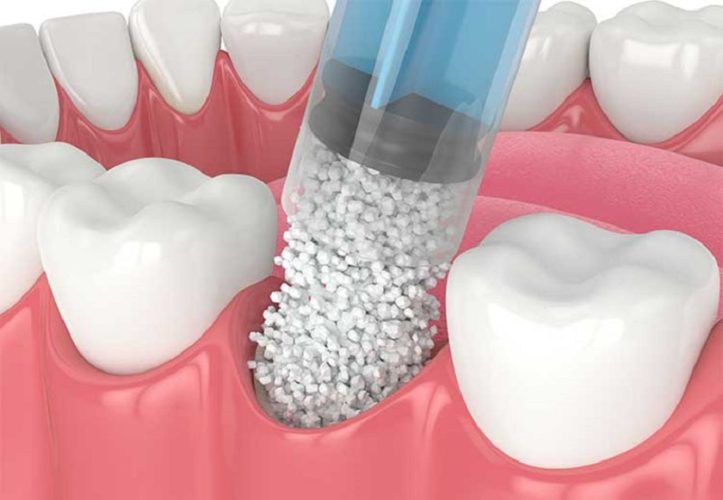 Phương pháp ghép xương trong phục hình răng Implant