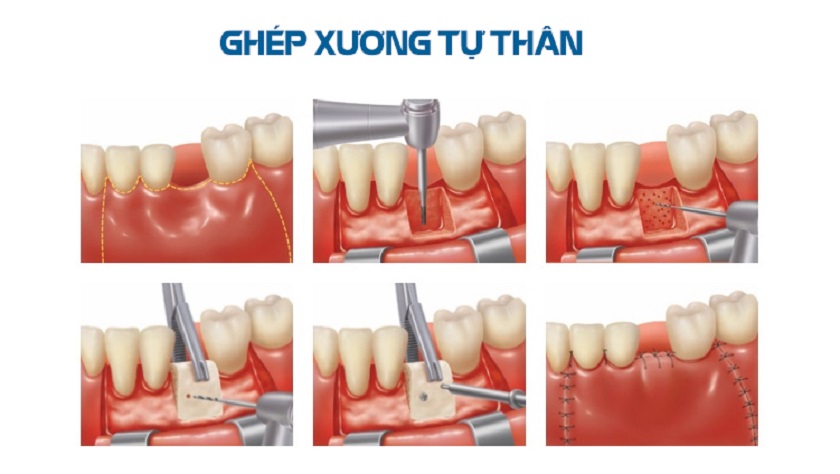 Ghép xương tự thân