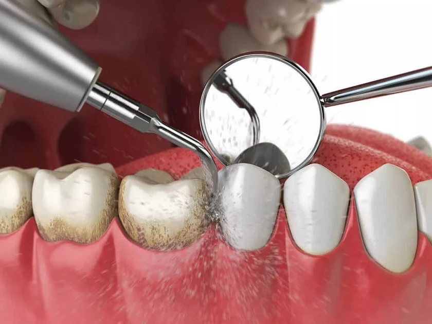 Khám phá ngay giá trồng răng sứ Implant chi tiết nhất 2023 31 Cạo vôi răng miễn phí Implant Center