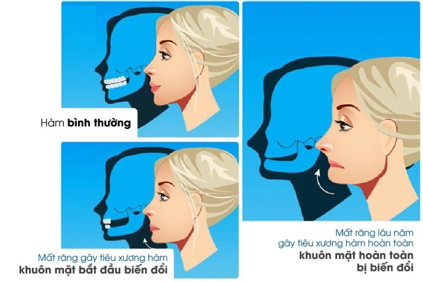 Giá trồng răng hàm Implant tại Implant Center 7 Cau truc guong mat thay doi do mat rang