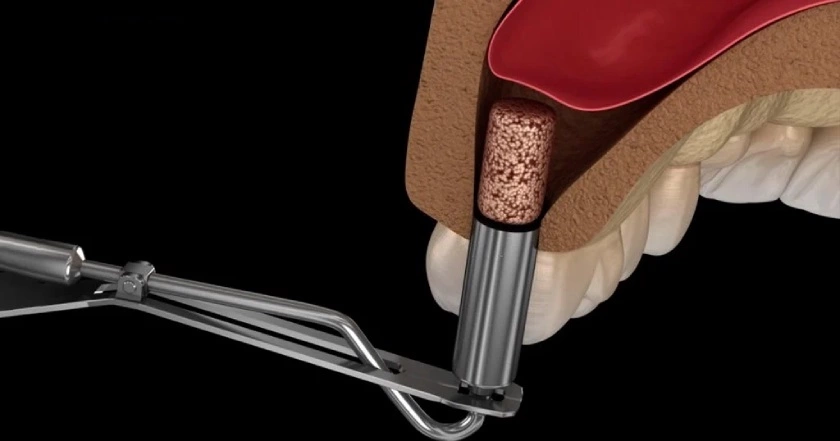 Giá trồng răng hàm Implant tại Implant Center 25 Ghep xuong nang xoang trong truong hop tieu