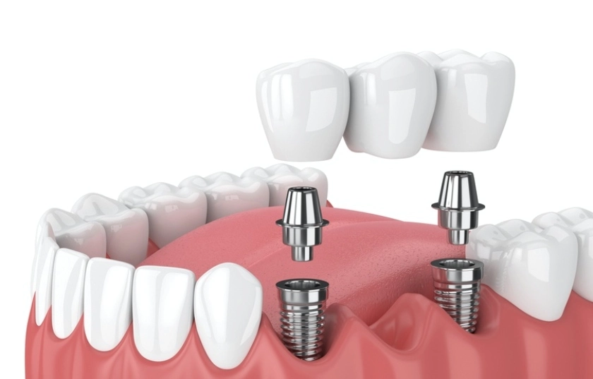 Giá trồng răng hàm Implant tại Implant Center 9 Gia trong rang ham implant