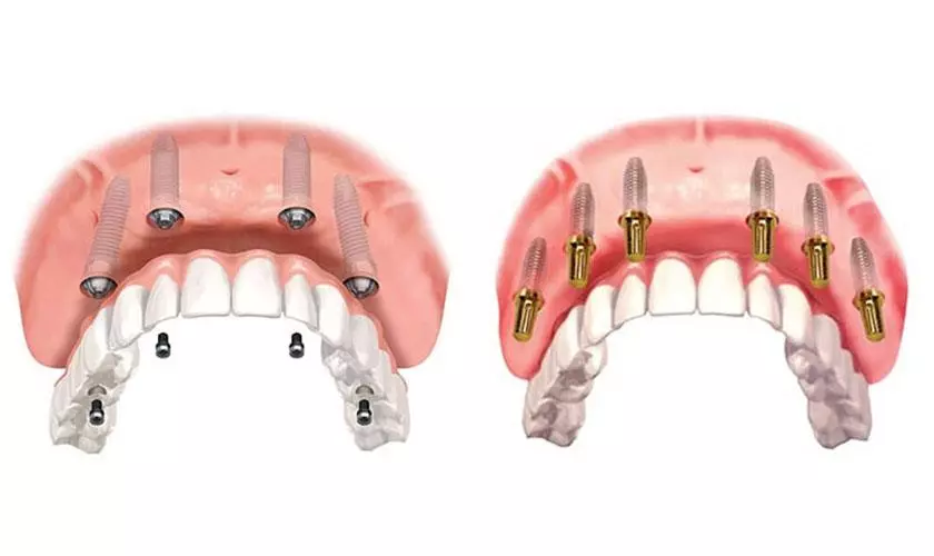 Khám phá ngay giá trồng răng sứ Implant chi tiết nhất 2023 39 Gia trong rang implant toan ham