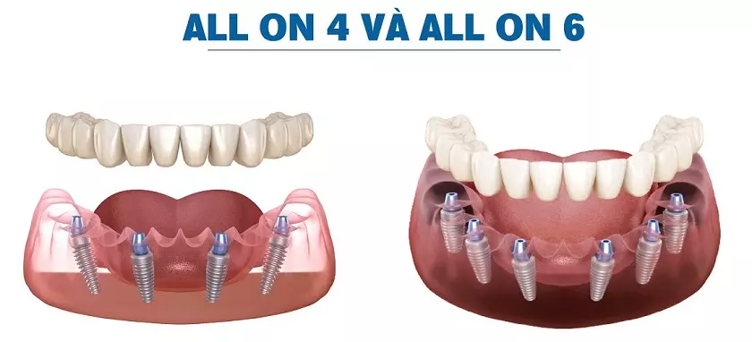 Mô phỏng kỹ thuật trồng răng implant toàn hàm