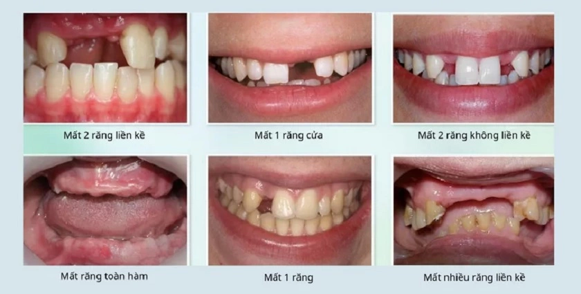 Giá trồng răng hàm Implant tại Implant Center 23 Số lượng răng mất quyết định giá trồng răng Implant