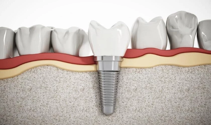 Khám phá ngay giá trồng răng sứ Implant chi tiết nhất 2023 24 Trồng răng sứ Implant bảo tồn răng bên cạnh