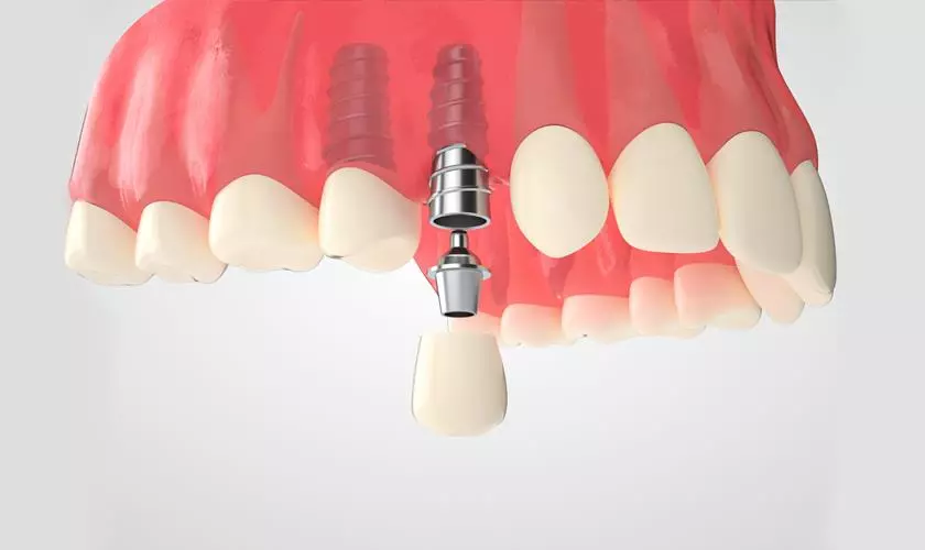 Khám phá ngay giá trồng răng sứ Implant chi tiết nhất 2023 28 Trồng răng sứ implant giá bao nhiêu