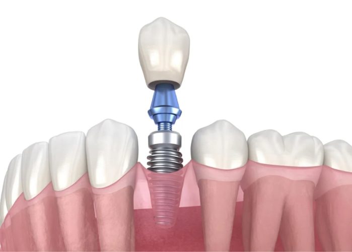 Phương pháp trồng răng Implant