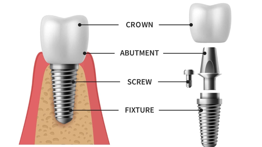 Răng giả được gắn lên trên Implant thông qua khớp nối Abutment