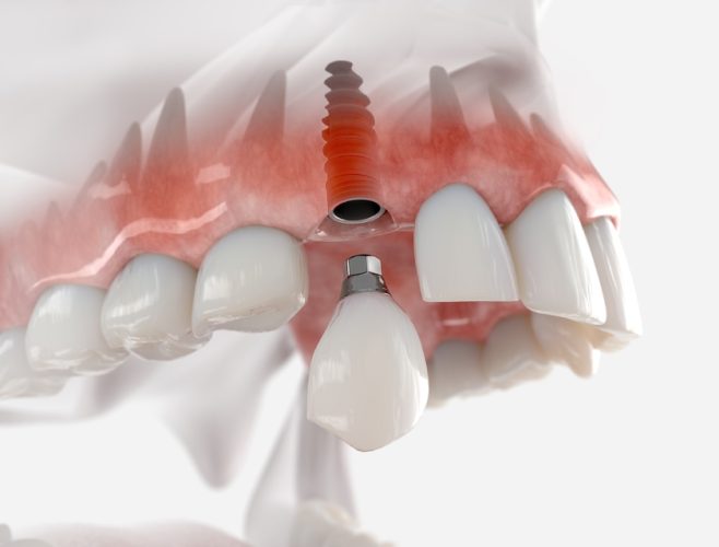 Trồng răng Implant đơn lẻ là một trong các phương pháp trồng răng Implant hiện nay