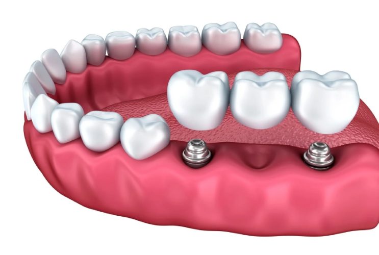 Cầu răng trên Implant