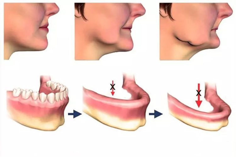 Khuôn mặt lão hóa dần vì tiêu xương lâu năm không được phục hồi
