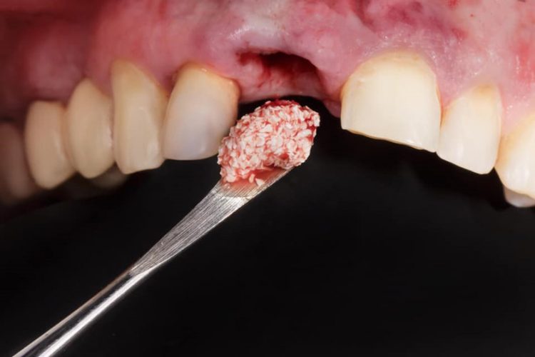 Nếu tiêu xương quá nhiều, khách hàng cần phải ghép xương trước khi cấy ghép Implant