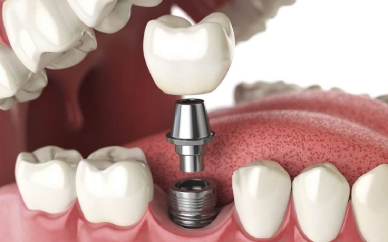Implant tức thì là kỹ thuật đặt Implant vào xương hàm ngay sau khi nhổ răng