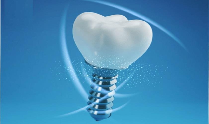 Một số chú ý khi trồng răng Implant cần biết