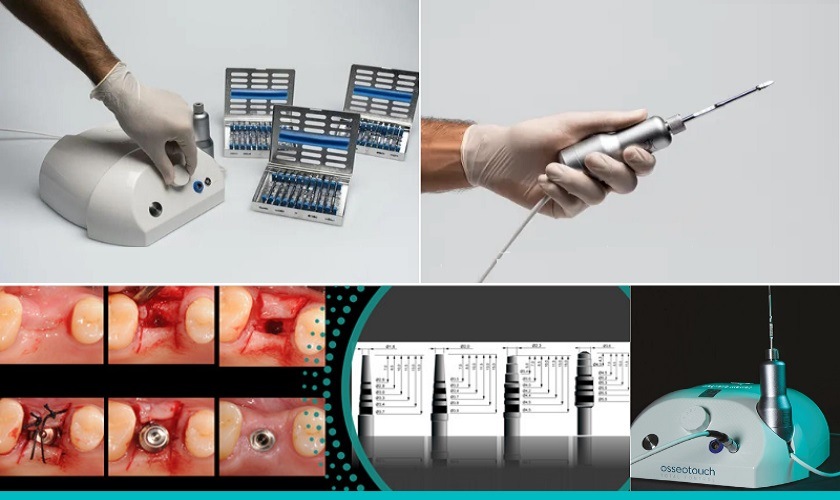 Tìm hiểu về công nghệ từ tính trong cấy ghép Implant