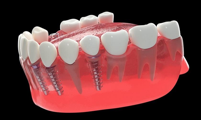Những điều bạn cần biết về điều kiện để trồng răng Implant