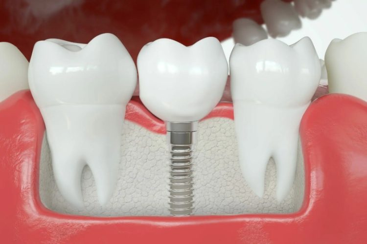 Trồng răng hàm Implant