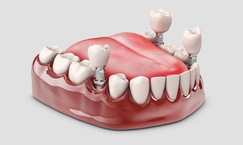 Trồng răng Implant giải pháp khôi phục răng mất hiệu quả