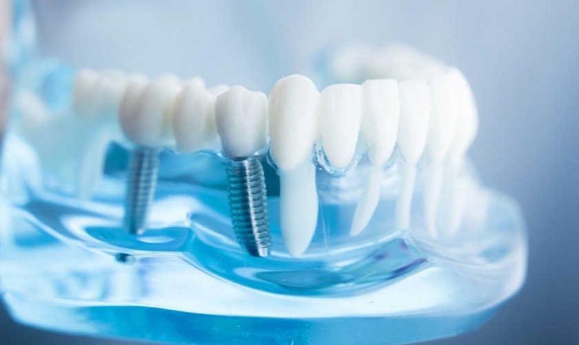 Răng Implant bị hỏng – Nguyên nhân, biểu hiện và cách xử lý