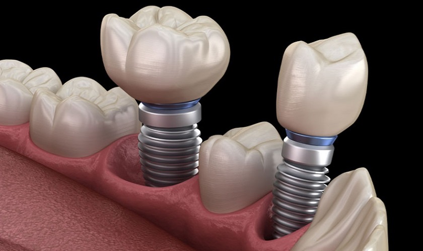 Trồng Implant khi khoảng trống răng bị mất quá hẹp