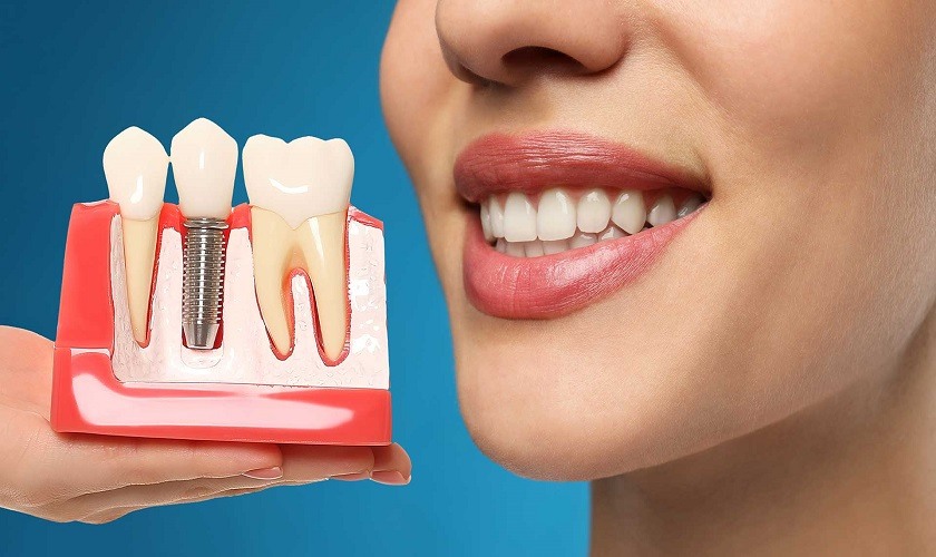 Trồng răng trụ Implant: Giải pháp phục hồi răng tối ưu