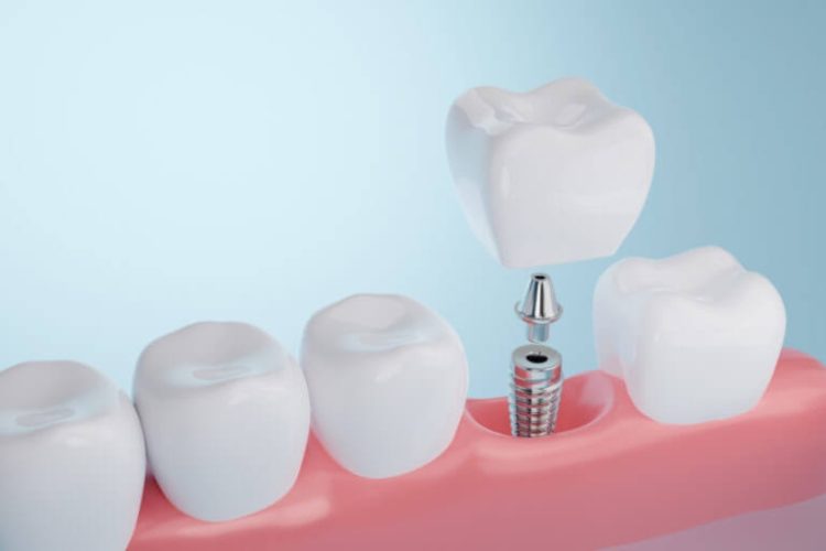 Kỹ thuật trồng răng trụ Implant trong nha khoa hiện đại