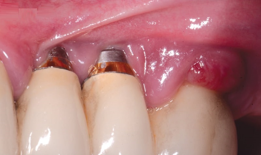 Lộ trụ Implant – Nguyên nhân, hậu quả và cách điều trị