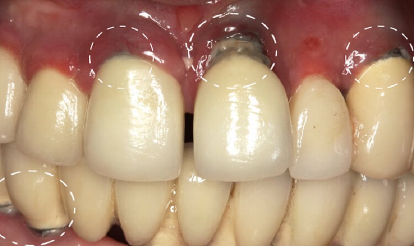 Tình trạng trụ Implant bị lộ ra ngoài