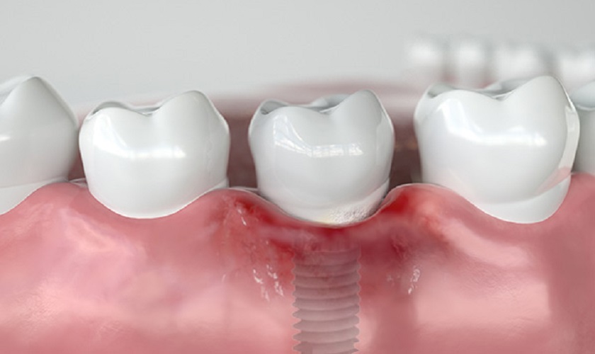 Tại sao lợi chuyển màu đen xung quanh trụ Implant?