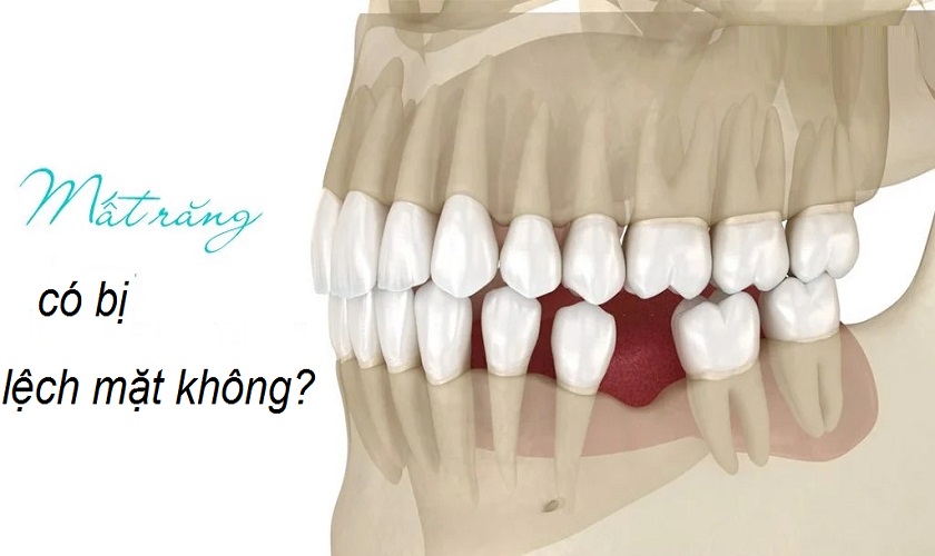 Mất răng có bị lệch mặt không? Khắc phục như thế nào?