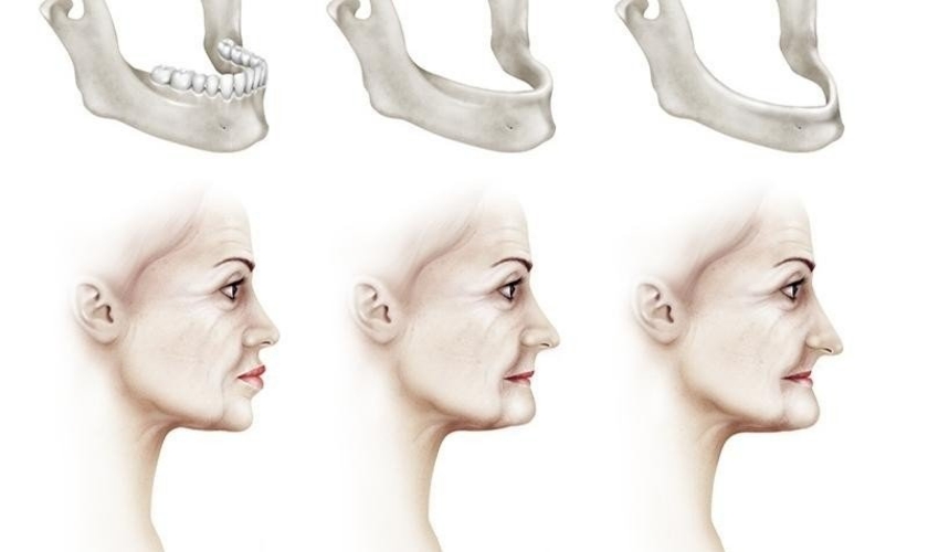 Khách hàng bị tiêu xương hàm do mất răng lâu năm