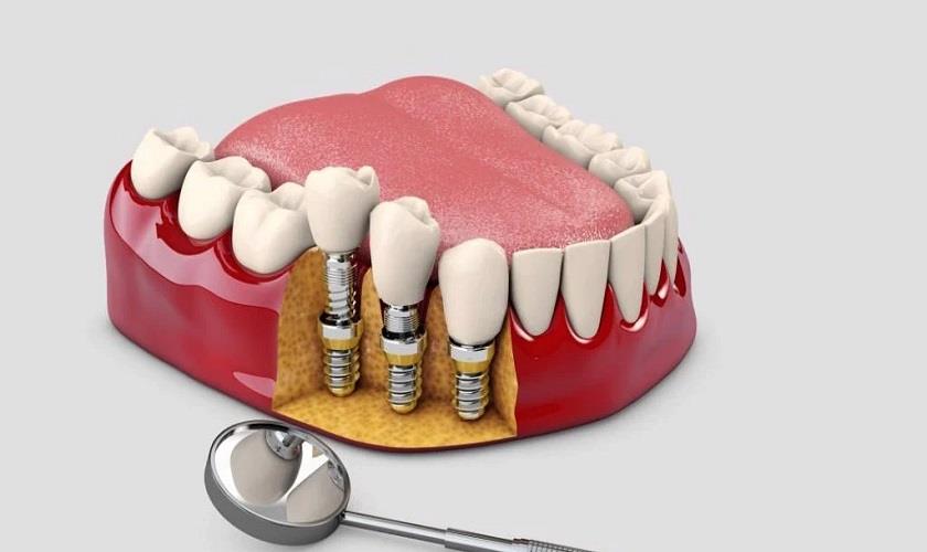Trồng răng Implant giải pháp khôi phục mất răng lâu năm hiệu quả