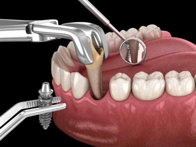 Trồng Implant tức thì ngay sau khi nhổ răng