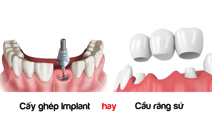 Nên trồng răng Implant hay bắc cầu răng sứ?