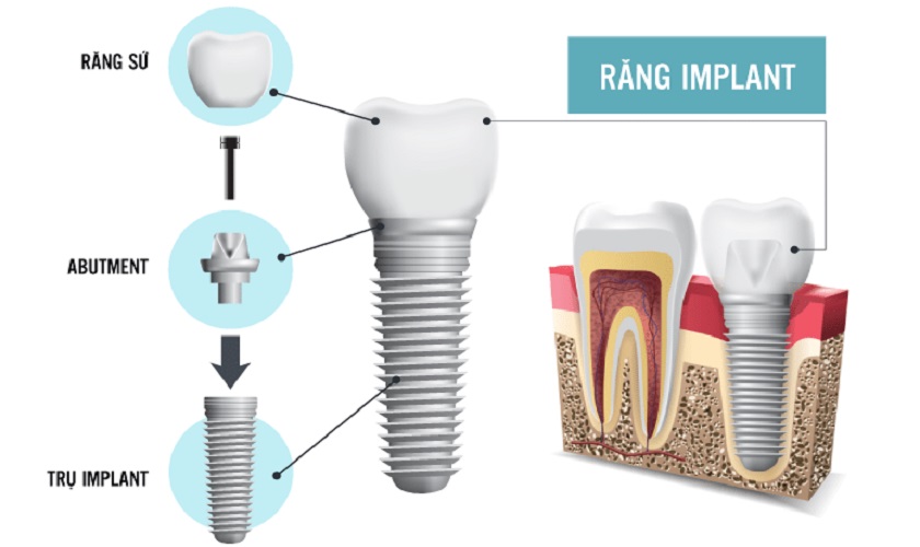 Răng Implant có cấu tạo tương tự như răng thật mang lại nhiều lợi ích cho người dùng