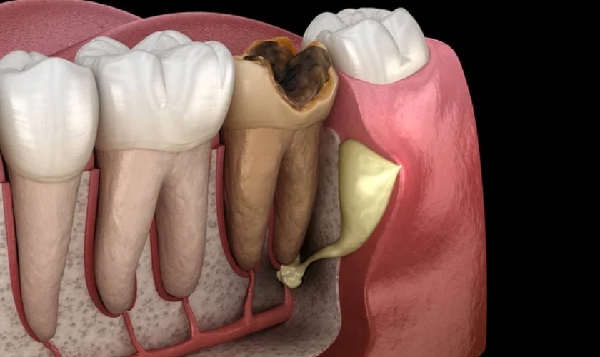 Nên trồng răng Implant hay điều trị tủy răng?