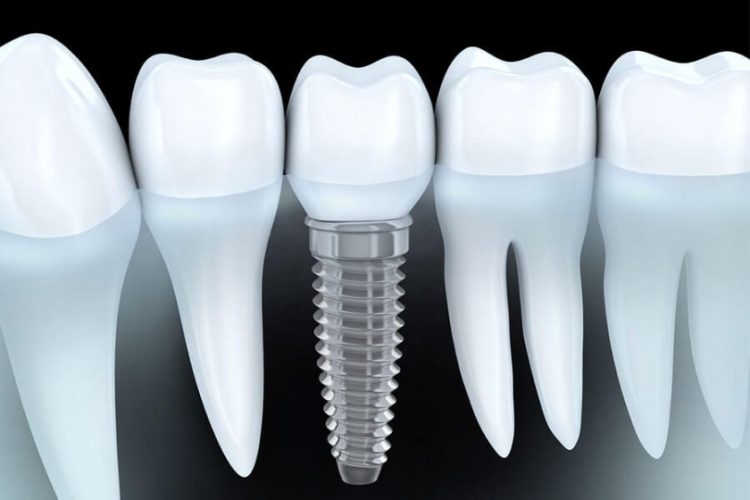 Phương pháp phục hình răng mất bằng trồng Implant