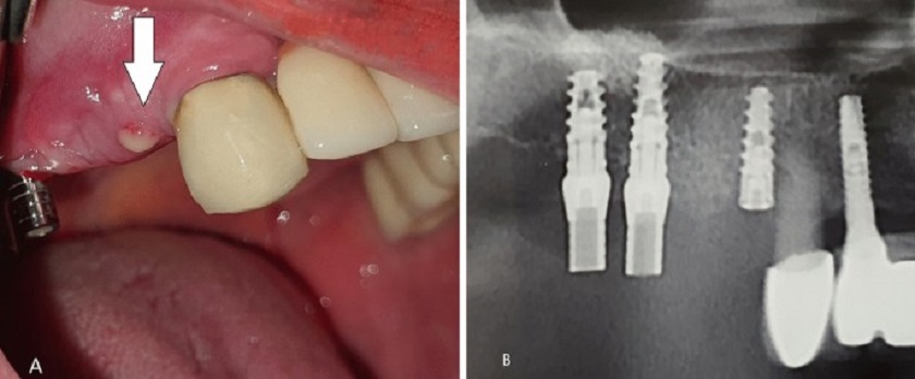 Nhiễm trùng sau khi trồng răng Implant