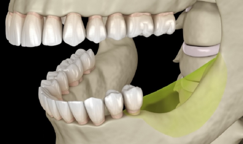 Nhổ răng không trồng lại có sao không? Nhổ răng không trồng lại gây tiêu xương hàm