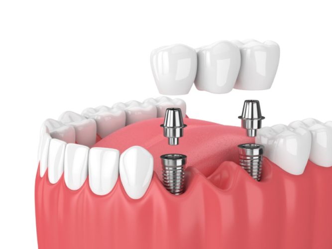 Tái tạo răng mất bằng Implant nha khoa